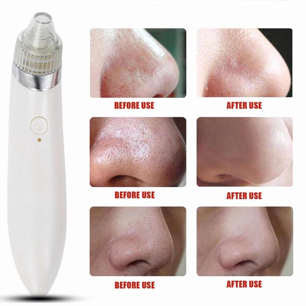 Acne Pore Vacuum Cleaner-Blackhead Remover-Beauty Expert